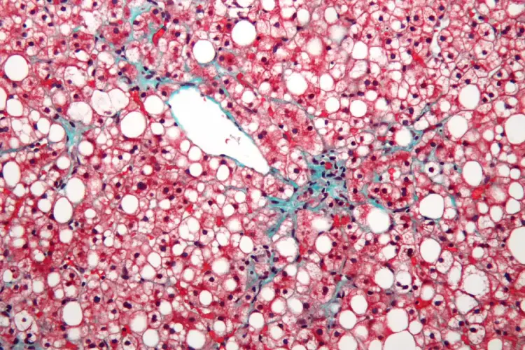 Urgent need to combat fatty liver epidemic in India